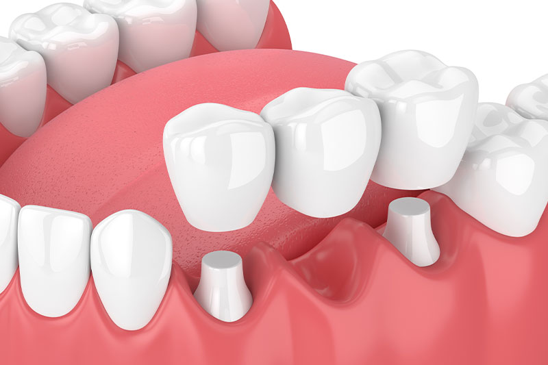 Dental Bridges in Concord