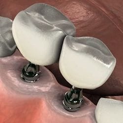 Dental implants.