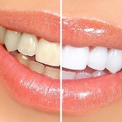 instead of metal fillings, white fillings.