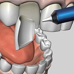 instead of metal fillings, white fillings.